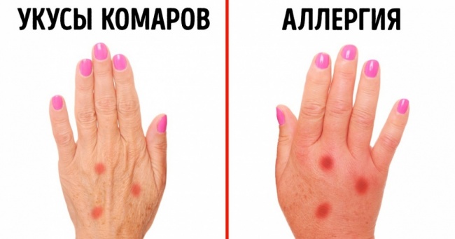 3 ознаки, які допоможуть розпізнати алергію