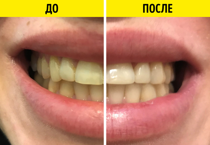 Різні методи відбілювання зубів: який обрати?
