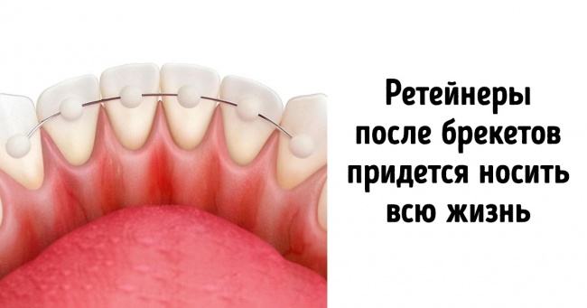 11 найпопулярніших питань про брекетах, відповіді на які варто дізнатися перед їх установкою