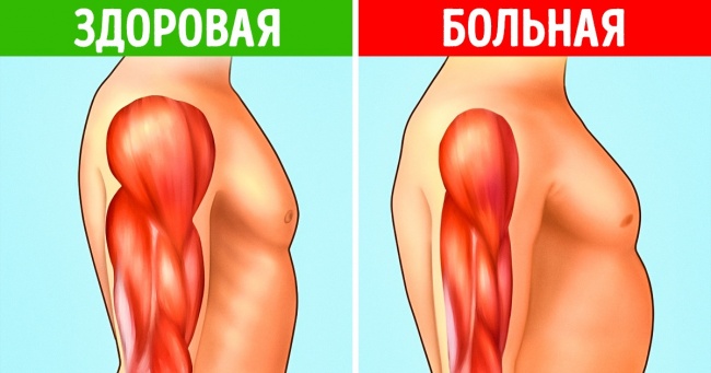 Дегенерація м'язів починається з 8 ранніх симптомів. Не ігноруйте їх