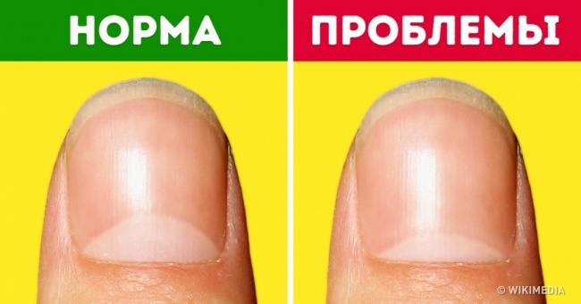 13 проблем зі здоров'ям, про які попереджають лунки на нігтях