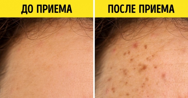 Які медикаменти несумісні з засмагою (Їх поєднання може бути дуже небезпечно)