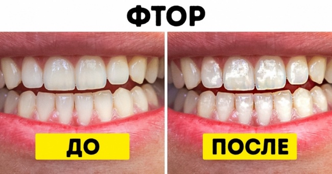 10 популярних продуктів, які завдають непоправної шкоди вашим зубам